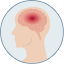 small scale illustration of cloudy spot on the brain (representing seizures)