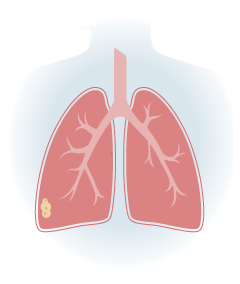 Stage 1 Pleural Mesothelioma Illustration