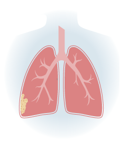 Stage 2 Pleural Mesothelioma Illustration