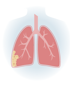 Stage 3 Pleural Mesothelioma Illustration
