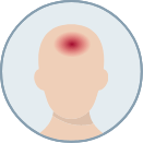 small scale illustration of hot spot on the forehead (representing fever)