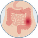 small scale illustration of blockage in the intestines