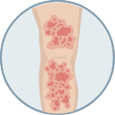 small scale illustration of fluid collecting in legs