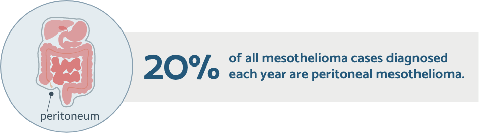 20% of all mesothelioma cases diagnosed each year are peritoneal mesothelioma.