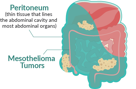 Illustration of Peritoneal Mesothelioma