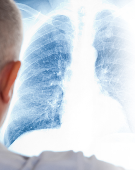 looking over medical professional's shoulder at chest x-ray film on a lightboard